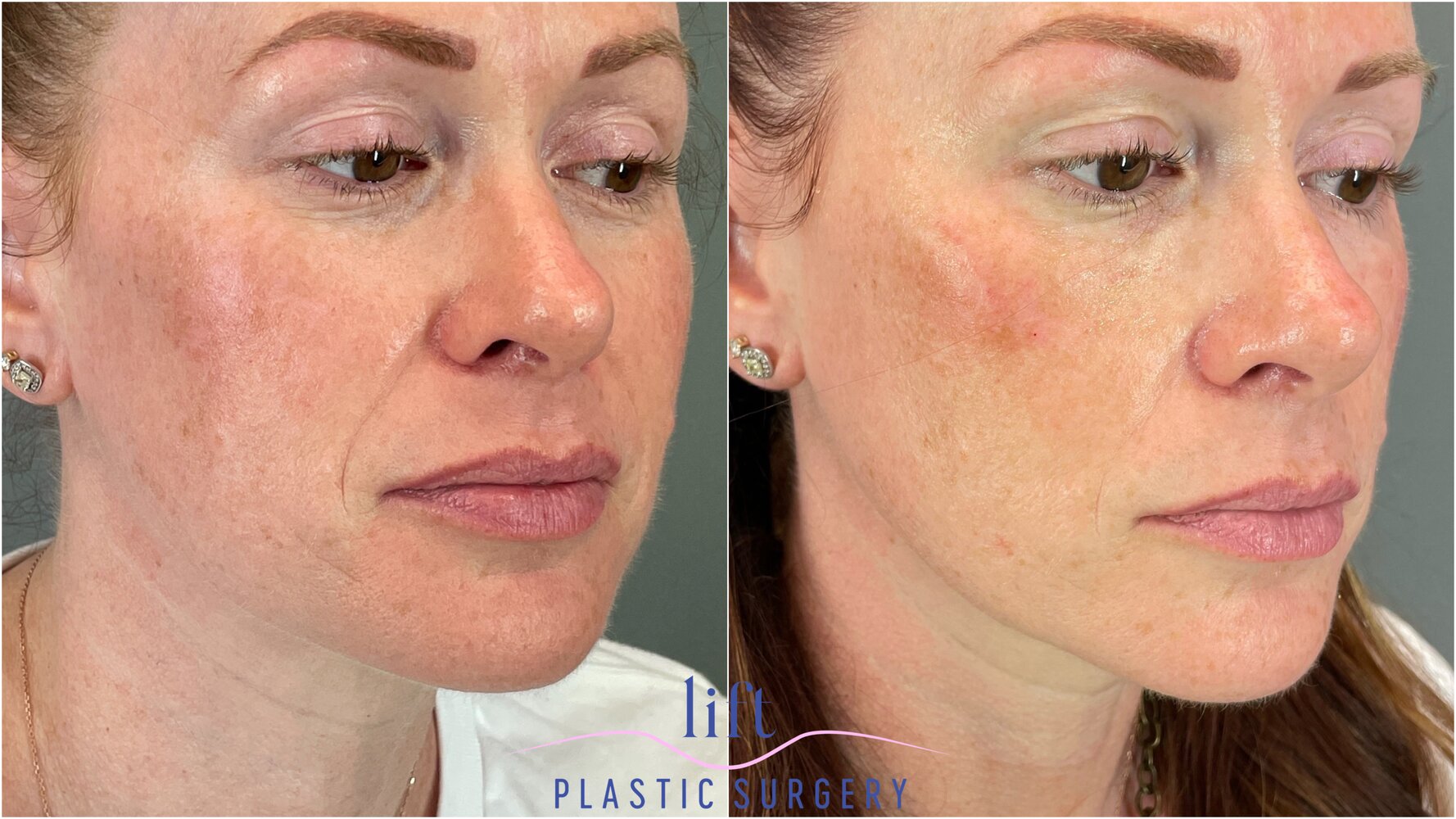 Injectables Before &#038; After Photos