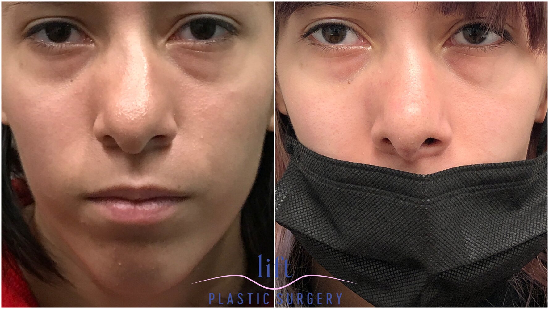 Rhinoplasty Before &#038; After Photos