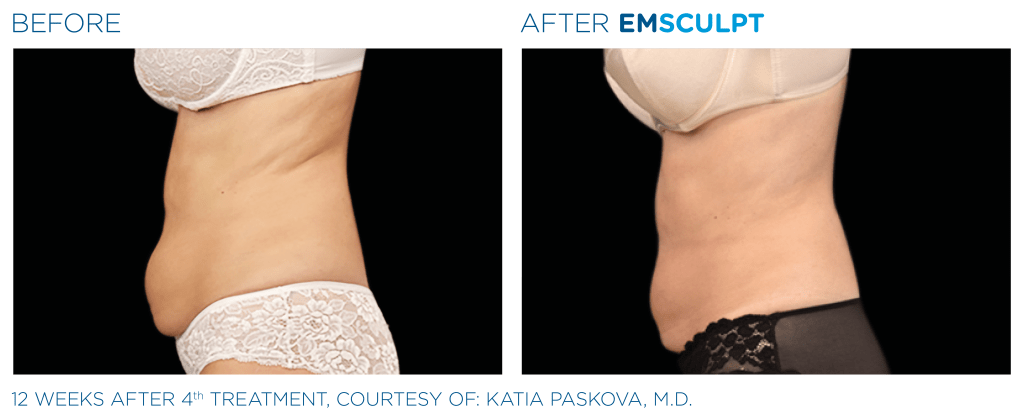 EMSCULPT