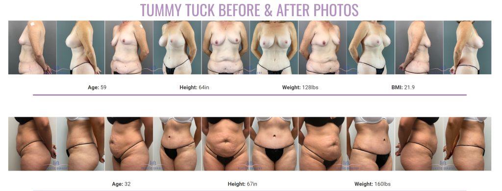 Abdominoplasty