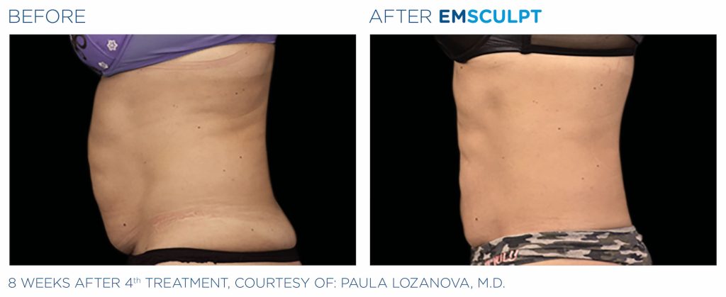 Body and Muscle Contouring with EMSCULPT
