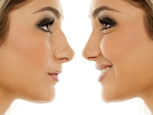 Rhinoplasty