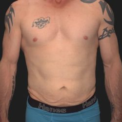 Tummy Tuck Before & After Patient #3857