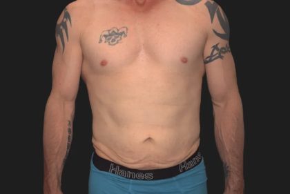 Tummy Tuck Before & After Patient #3857