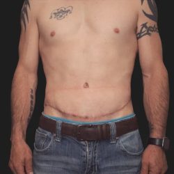 Tummy Tuck Before & After Patient #3857