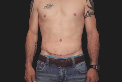 Tummy Tuck Before & After Patient #3857