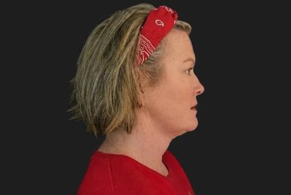 Neck Lift Before & After Patient #3842