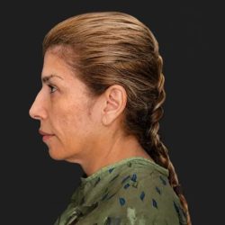 Facelift Before & After Patient #3840