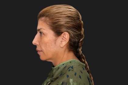 Facelift Before & After Patient #3840