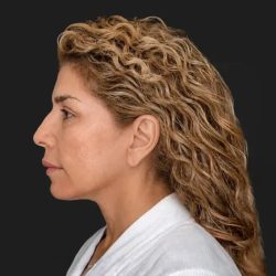 Facelift Before & After Patient #3840