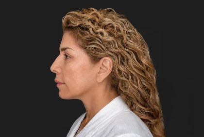 Facelift Before & After Patient #3840
