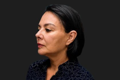 Facelift Before & After Patient #3841