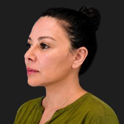 Facelift Before & After Patient #3841