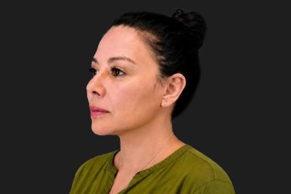 Facelift Before & After Patient #3841