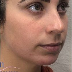 Injectables&Fillers Before & After Patient #125