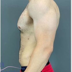 Liposuction Before & After Patient #188