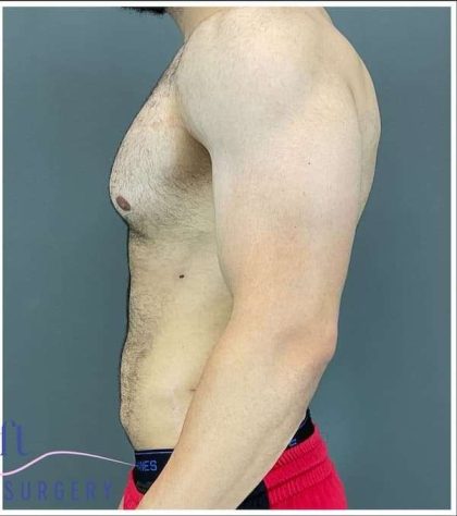 Liposuction Before & After Patient #188