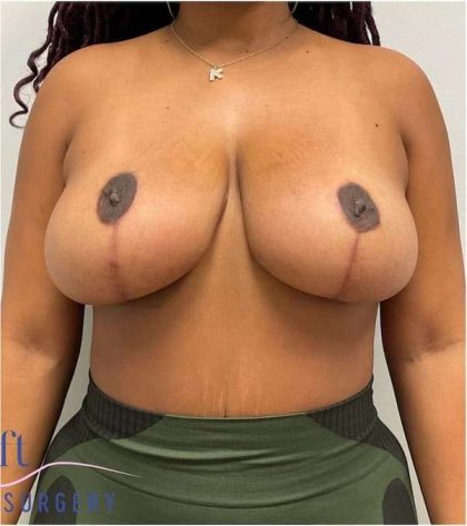 Breast Lift Before & After Patient #1098