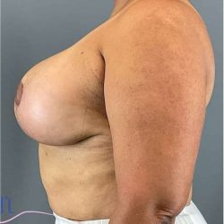 Breast Lift Before & After Patient #1131