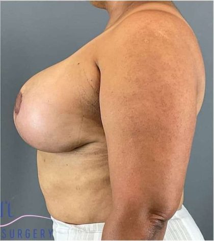 Breast Lift Before & After Patient #1131