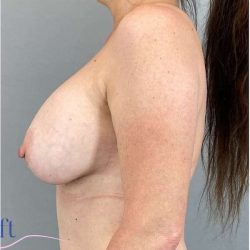 Breast Implant Exchange Before & After Patient #1142