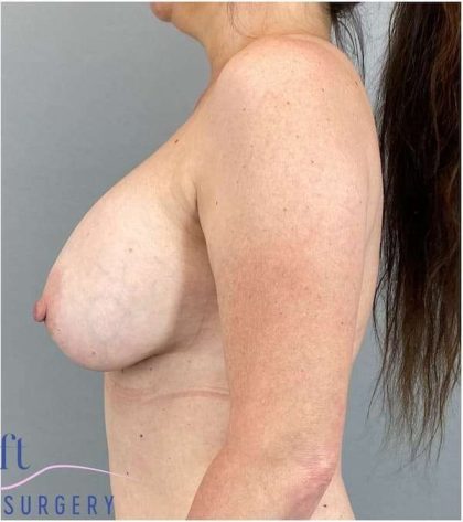 Breast Implant Exchange Before & After Patient #1142