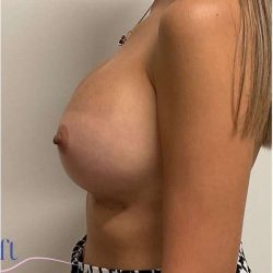 Breast Implant Exchange Before & After Patient #1153