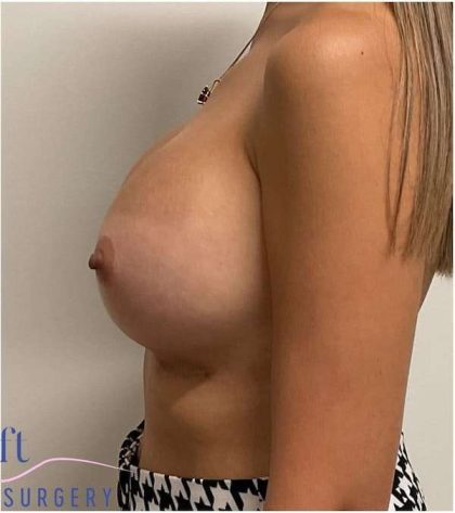 Breast Implant Exchange Before & After Patient #1153