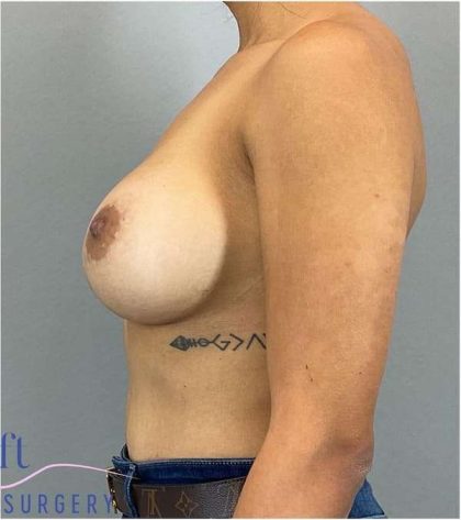 Breast Implant Exchange Before & After Patient #1164
