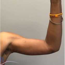 Arm Lift Before & After Patient #193