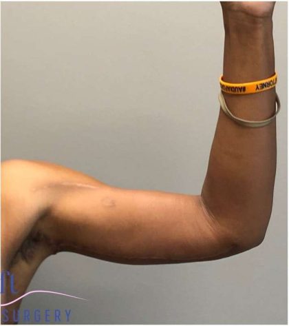 Arm Lift Before & After Patient #193