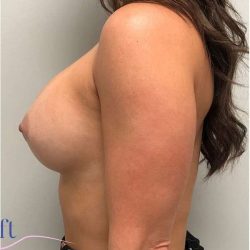Breast Implant Exchange Before & After Patient #1186