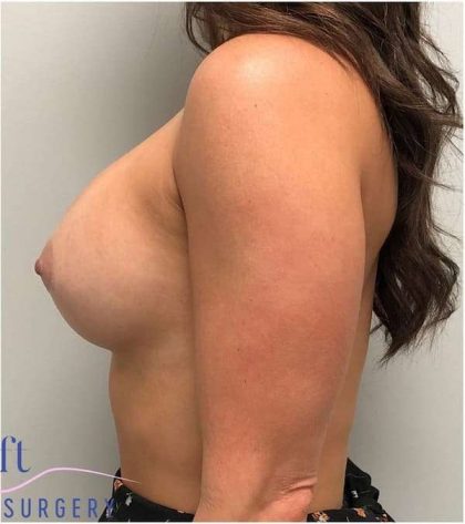 Breast Implant Exchange Before & After Patient #1186