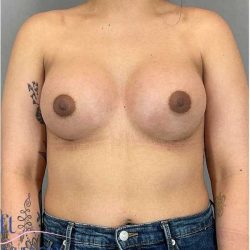 Breast Augmentation Before & After Patient #1219