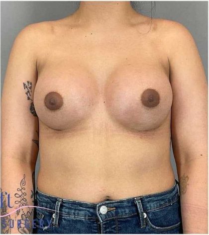 Breast Augmentation Before & After Patient #1219