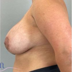 Breast Augmentation Before & After Patient #1230
