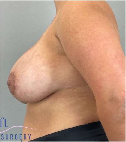 Breast Augmentation Before & After Patient #1230