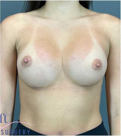 Breast Augmentation Before & After Patient #1252