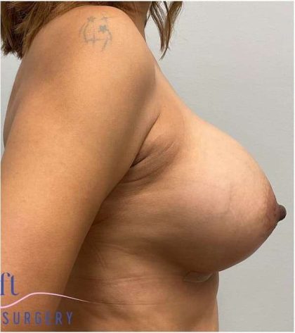 Breast Augmentation Before & After Patient #1274
