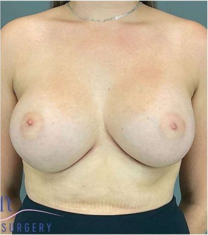 Breast Augmentation Before & After Patient #1285