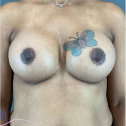 Breast Augmentation Before & After Patient #1296