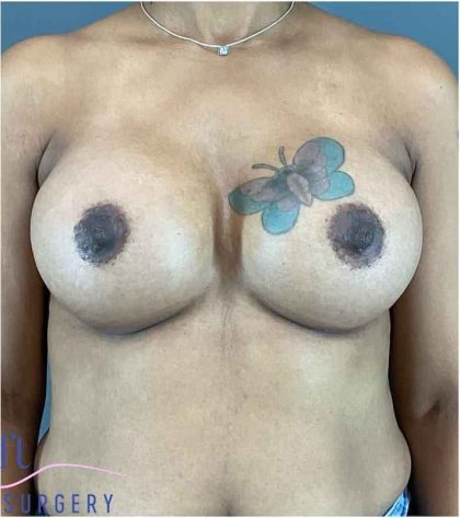 Breast Augmentation Before & After Patient #1296