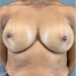 Breast Augmentation Before & After Patient #1307