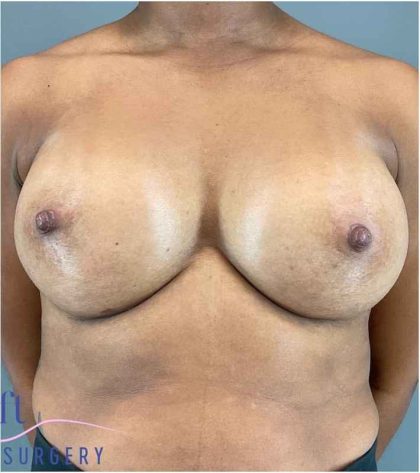Breast Augmentation Before & After Patient #1307