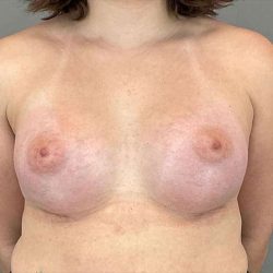 Breast Augmentation Before & After Patient #1362