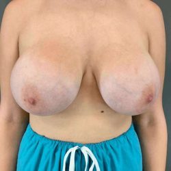 Breast Augmentation Before & After Patient #1384