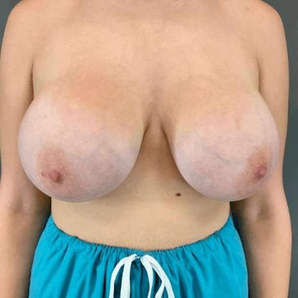 Breast Augmentation Before & After Patient #1384