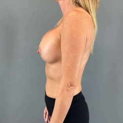 Breast Augmentation Before & After Patient #1439