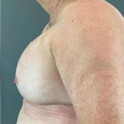 Breast Augmentation Before & After Patient #1450