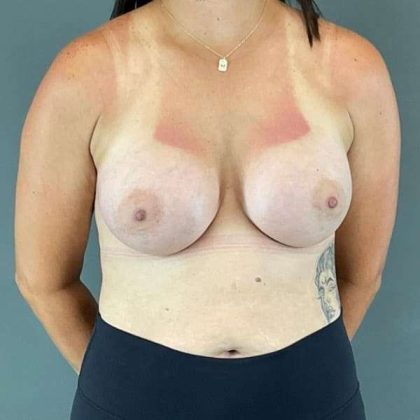 Breast Augmentation Before & After Patient #1472